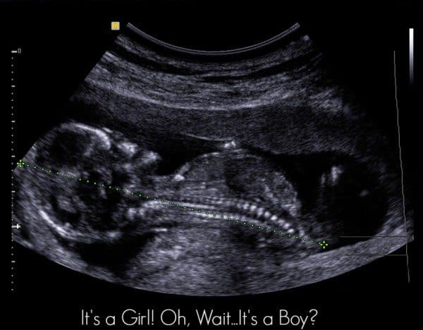 Baby's Sex Ultrasound Reveal Wrong